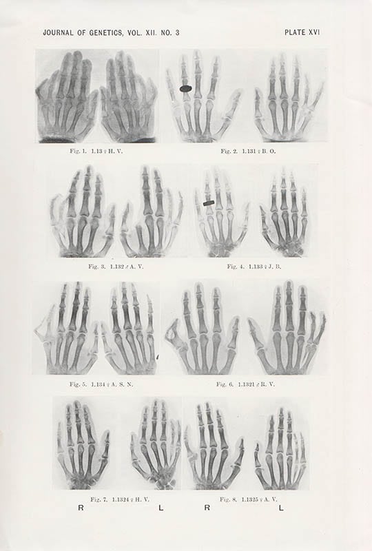 Aslaug Sverdrup : Postaxial polydactylism in six generations of a Norwegian family (With one Text-figure and Plates XV to XX)