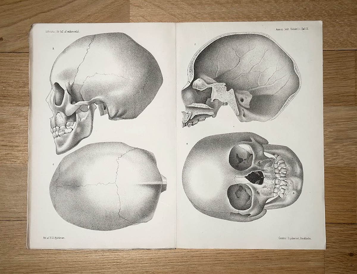 Gustaf Retzius : Ett fall af mikrocefali jämte en kort framställning af mikrocefalien i allmänhet (Med 12 träsnitt och 2 taflor i litografi)