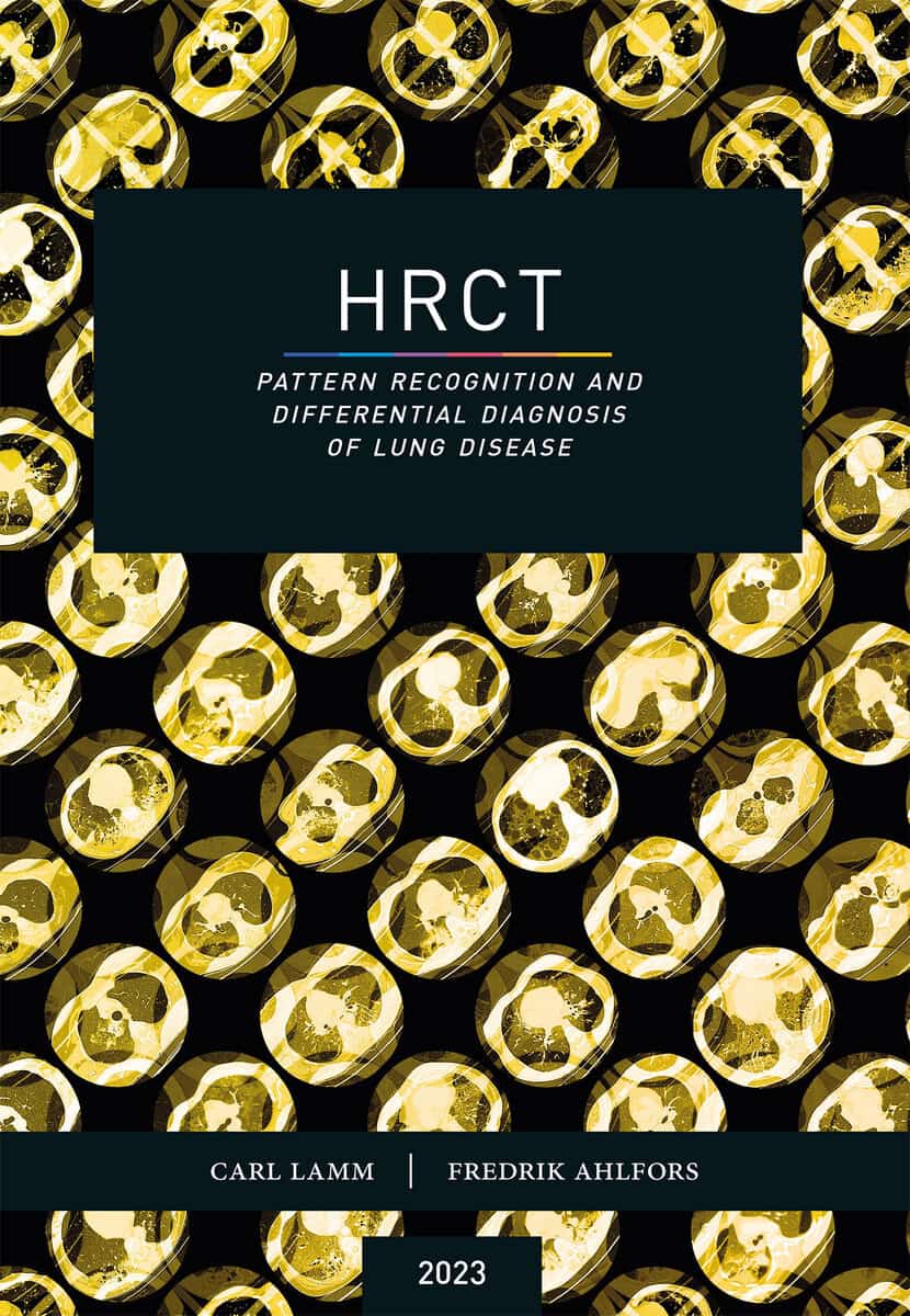 Lamm, Carl ; Ahlfors, Fredrik : HRCT : pattern recognition and differential diagnosis of lung disease