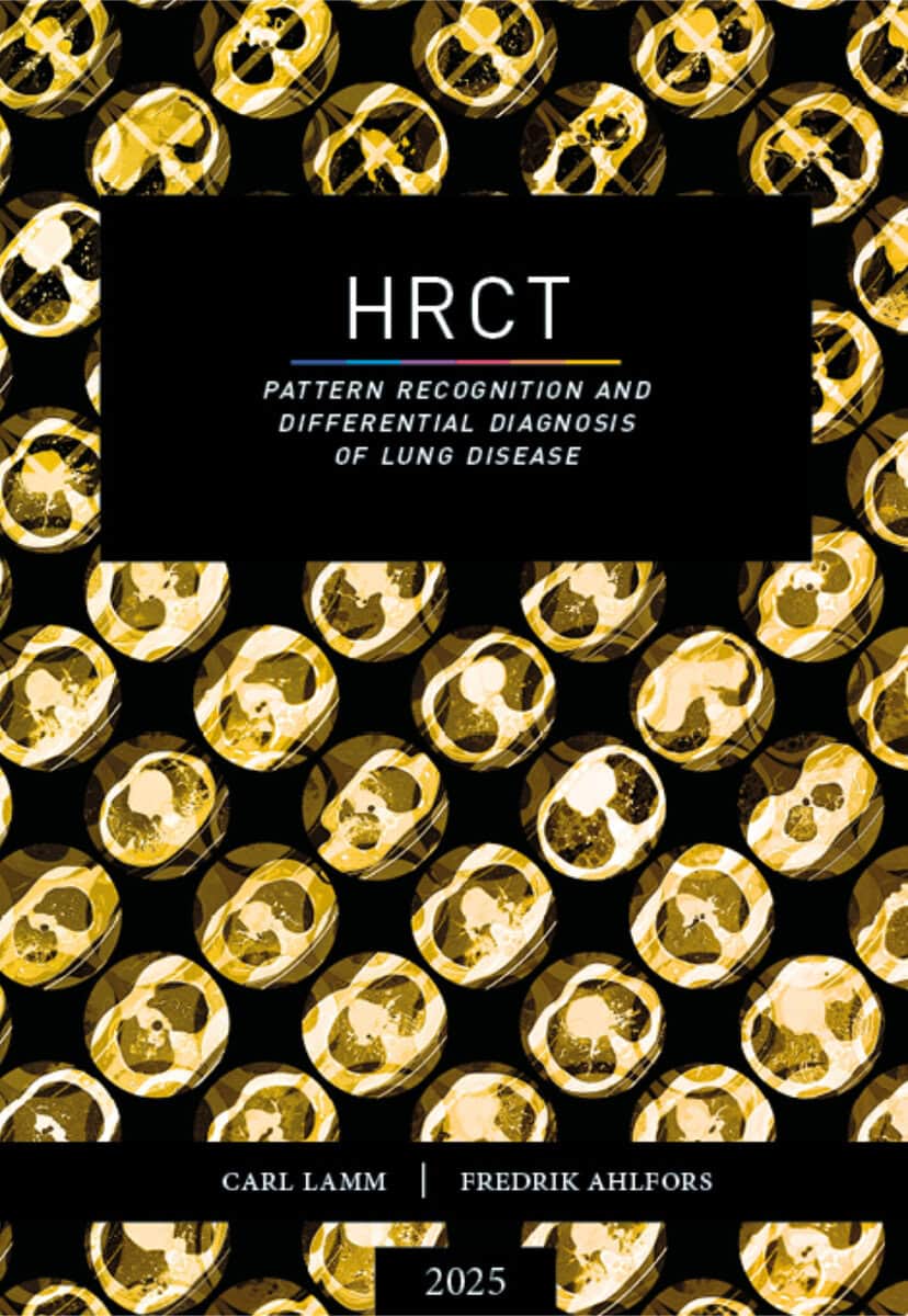 Lamm, Carl ; Ahlfors, Fredrik : HRCT : pattern recognition and differential diagnosis of lung disease