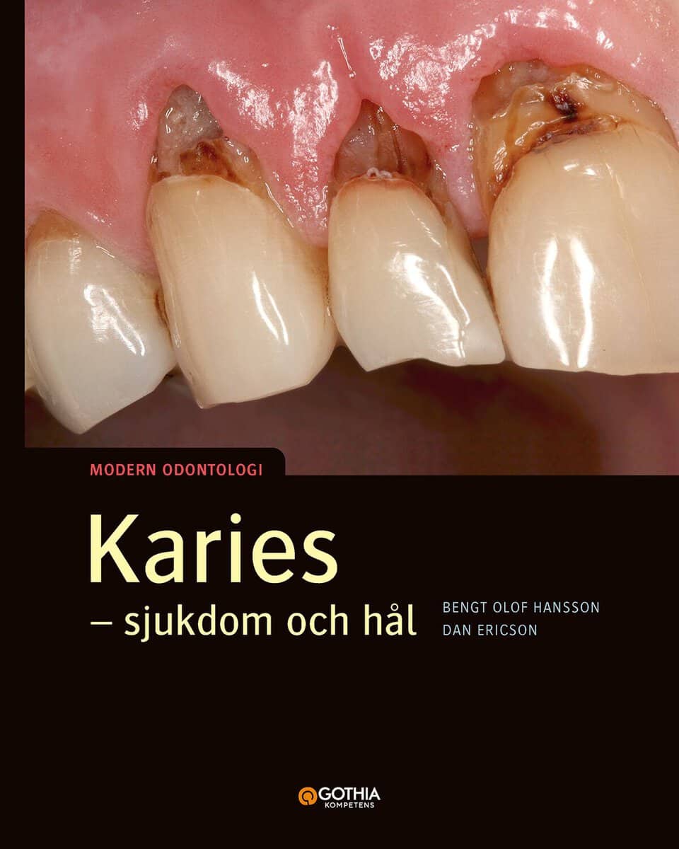 Hansson, Bengt Olof ; Ericson, Dan : Karies : sjukdom och hål