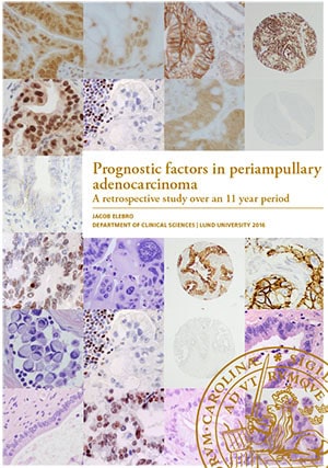 Jacob Elebro : Prognostic factors in periampullary adenocarcinoma