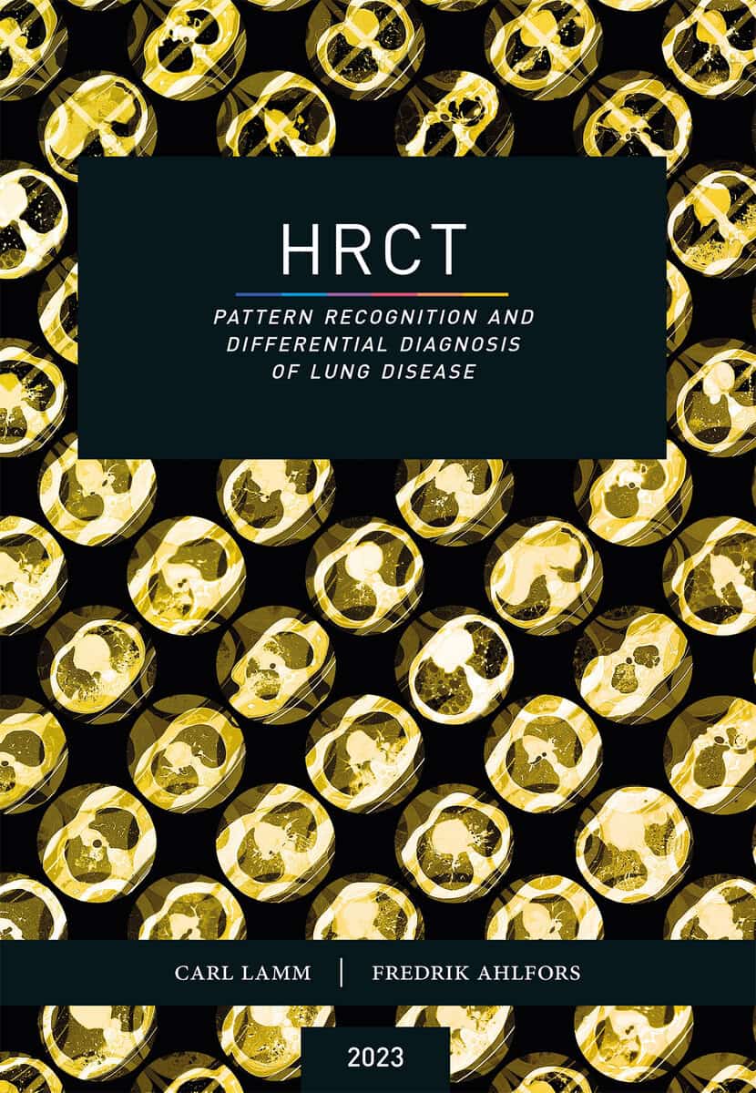Lamm, Carl ; Ahlfors, Fredrik : HRCT : pattern recognition and differential diagnosis of lung disease
