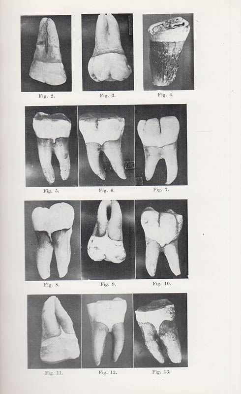 Pedersen, P. O. ; Thyssen, H. : Den cervicale emaljerands forløb hos eskimoer. En komparativ odontografisk undersøgelse af molarer fra eskimoer og andre racegrupper af homo samt nogle anthropomorfe aber